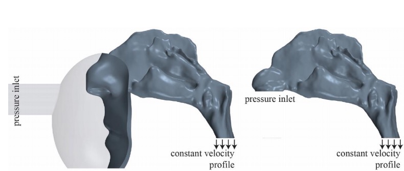Figure 1: Case study 190 - computational model (left) with part of the face and a simplified mask attached to the nasal cavity, and wall shear stress distribution (right) at the nasal cavity’s wall.